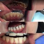 чистка зубов пример