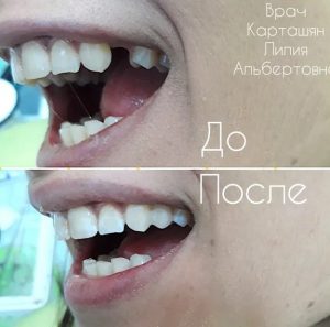 лечение зубов - до и после
