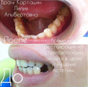 пример работ по реставрации зубов