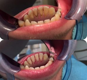пример работы по лечению зубов